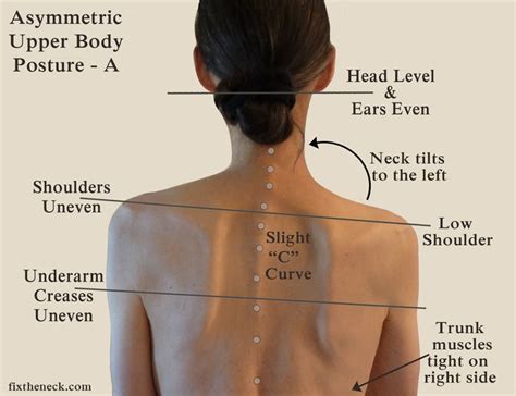 Collarbone Pain And Scoliosis Causes And Treatment Options Brandon