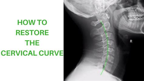 How To Restore The Cervical Curve Youtube