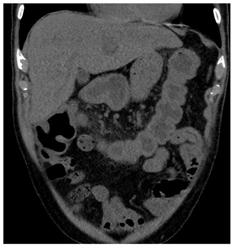 Imaging Case Of The Week 202 Answer Emergucate