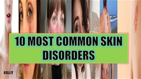 10 Most Common Skin Disordersdiseases In Humans Youtube