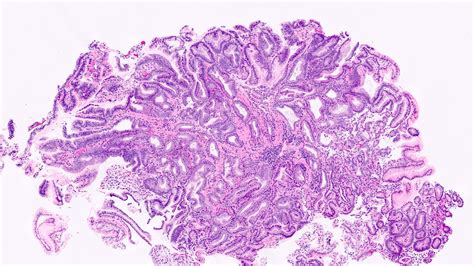 Pathology Outlines Adenomas