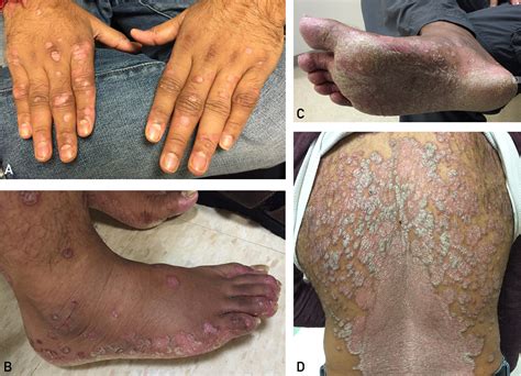 Chikungunya Virus Infectionassociated Psoriatic Arthritis Mayo