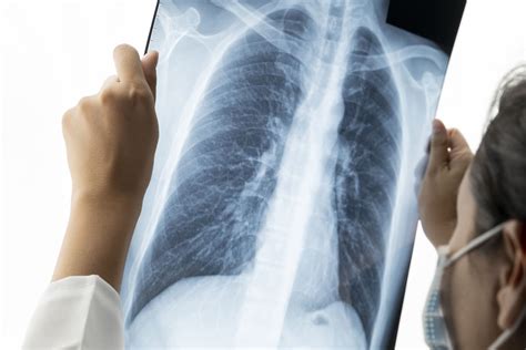 Digital Help For Lung Cancer Patients Newsroom