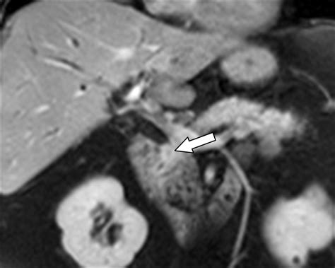Uncommon Intraluminal Tumors Of The Gallbladder And Biliary Tract