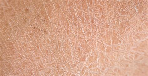 Dry Scaly Skin Treatment Dermatology Consultants Of South Florida