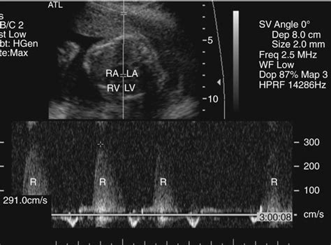 Atrioventricular Septal Defects Radiology Key