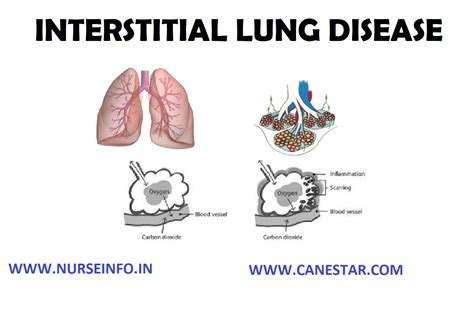 Interstitial Lung Disease Etiology Risk Factors Pathophysiology