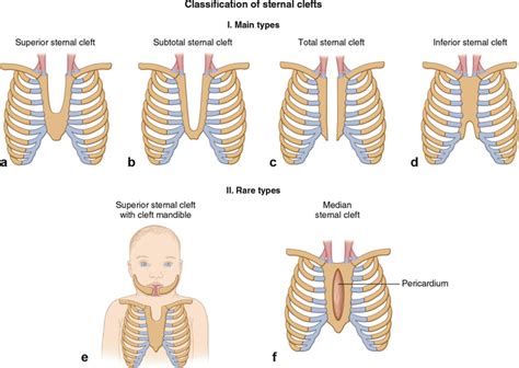 Other Chest Wall Deformities Thoracic Key