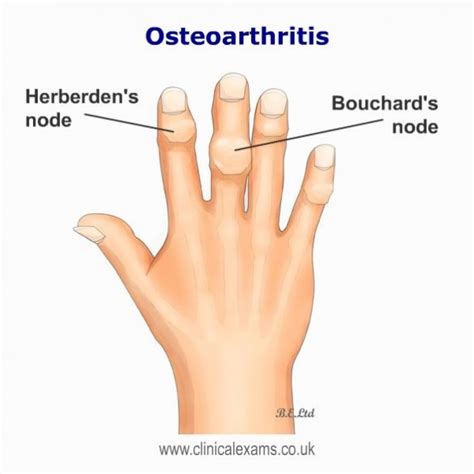 Heberdens And Bouchards Nodes Osteoarthritis