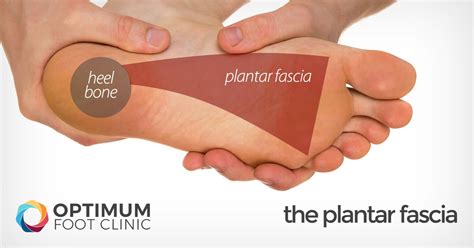 Plantar Fasciitis Heel Pain Explained Optimum Foot Clinic Lower
