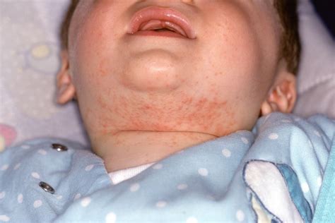 Contact Dermatitis Baby Neck Agatha Greenlee