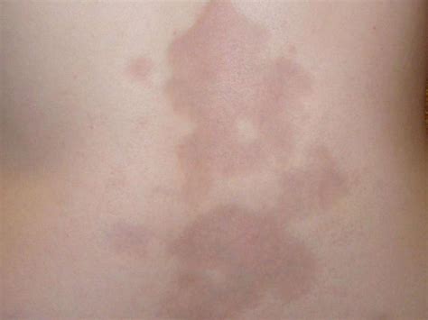 When To Worry About A Discolored Spot On Your Skin Heidi Salon