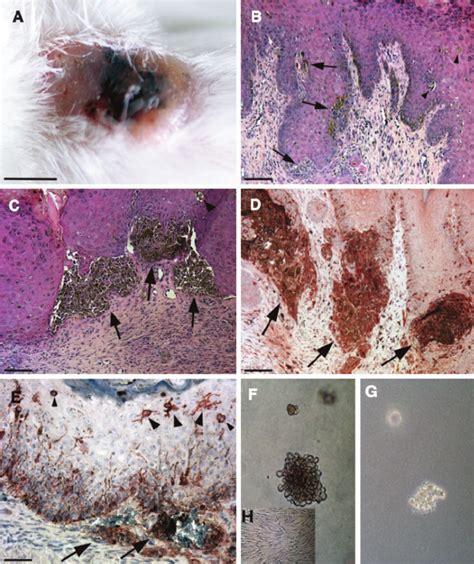 Melanomas In Human Skin Grafts Induced By Cutaneous Expression Of Basic Download Scientific