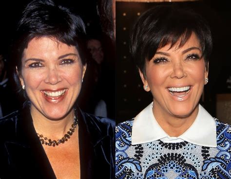 Kris Jenner From Better Or Worse Celebs Who Have Had Plastic Surgery