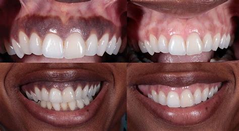 Laser Gum Bleaching In Houston Tx Progressive Dental Houston