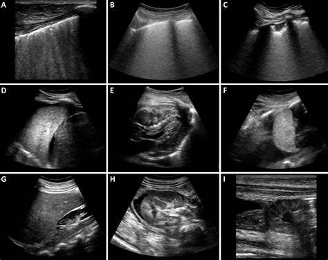 Figure 1 From Ultrasound Guided Minimally Invasive Tissue Sampling A