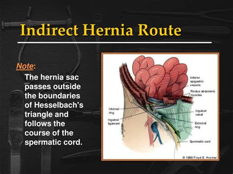 Ppt Inguinal Hernias Powerpoint Presentation Free Download Id218475