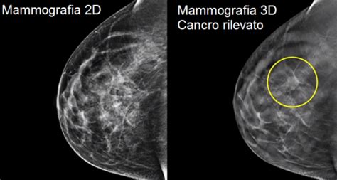 Mammografia Con Lo Screening 3D Scoperto Il 34 Di Tumori Al Seno In