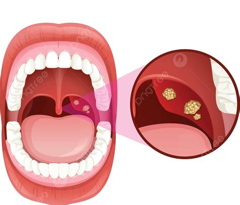 ヒトの口扁桃炎感染症 ヒトの医療ウイルス ベクターイラスト画像とpngフリー素材透過の無料ダウンロード Pngtree