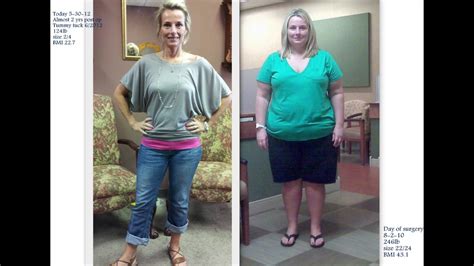 Gastric Bypass Surgery Pictures Before And After Gastric Sleeve