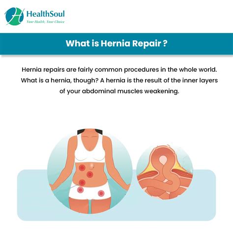 Indications For Hernia Repair Indications For Mesh Usage In Hiatal