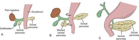 Anomalies And Anatomic Variants Of The Pancreas Radiology Key