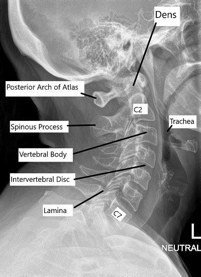 Anatomy Of The Spine Complete Orthopedics Multiple Ny Locations
