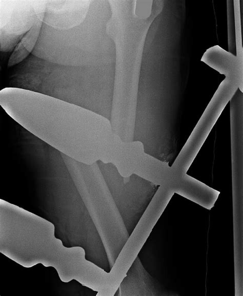 Broken Upper Leg Or Thigh Bone Femur Fracture Anterior View Completed