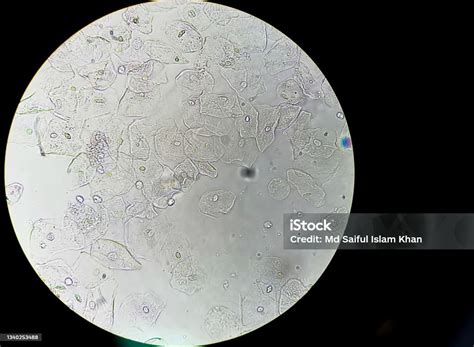 Hasil Abnormal Pemeriksaan Urinalisis Dari Metode Mikroskopis Di Bawah Mikroskop Cahaya 100x