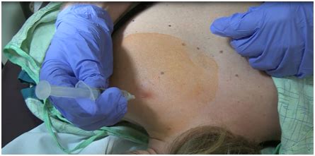 Understand when these injections are appropriate, how to set expectations with your physician, and cortisone's limitations. Emergency Medicine News