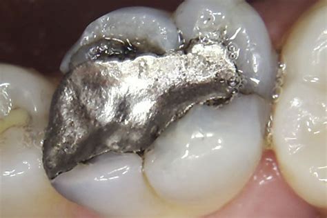 Cracked Tooth Syndrome Amalgam Replacement Rhondium Dental