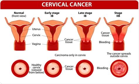 Hpv And Cervical Cancer
