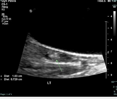 Nonobstetric Pelvic Ultrasound Showing 1 Cm Hyperechoic Left Ovarian