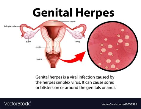 genital herpes infographic with explanation vector image