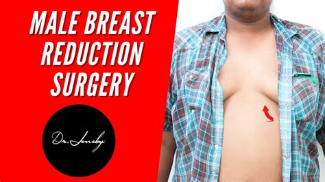 Male Breast Reduction Surgery Gynecomastia Dr Jeneby Youtube