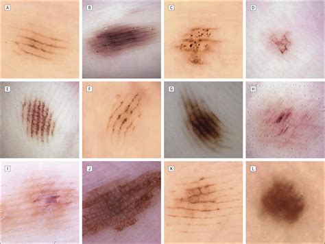 Variations In The Dermoscopic Features Of Acquired Acral Melanocytic