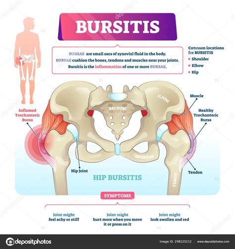 Bursitis Vector Illustration Labeled Bursae Synovial Inflammation