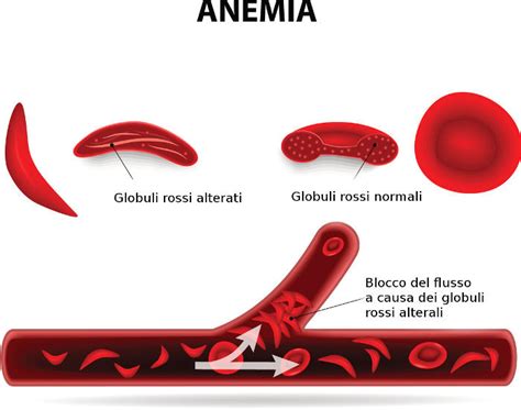 Anemia Falciforme Sintomi Genetica Cause E Cura