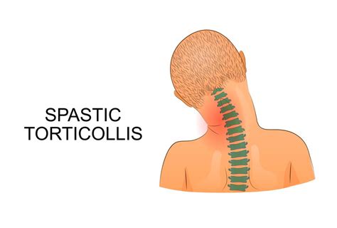 Torticollis Overview Causes Symptoms Treatment