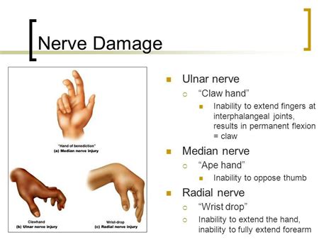Resultado De Imagen De Ulnar Radial Flexio Extension Ulnar Nerve Peripheral Nerve Nerve Palsy
