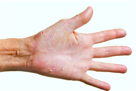 Fungus On The Hands Fingers Symptoms And Treatment • Human