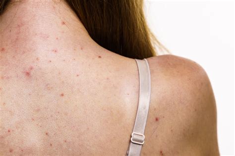 Shoulder Acne What It Is And How To Get Rid Of It Curology