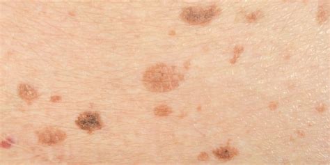 As We Grow Older Brown Spots Can Show Up On The Skin These Are
