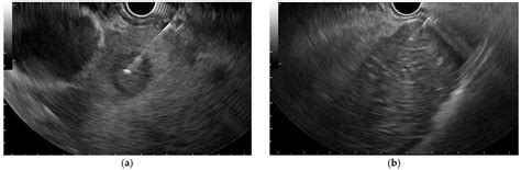 Diagnostics Free Full Text Endoscopic Ultrasound Guided Fine Needle