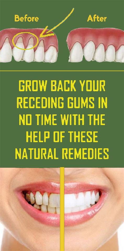 7 Natural Ways To Treat Receding Gums Receding Gums Natural Healing