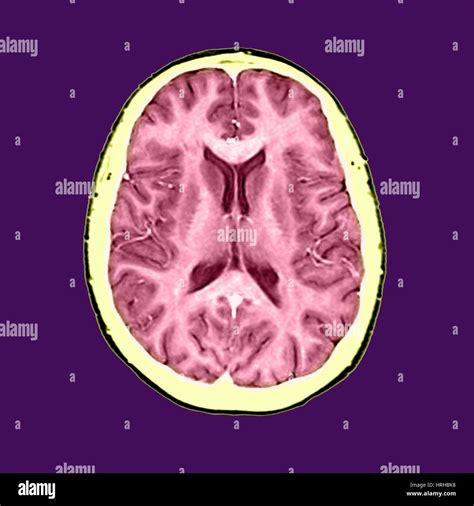 Normal Brain Mri Scans Hi Res Stock Photography And Images Alamy