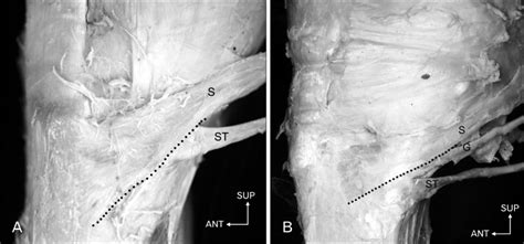 Typical Insertion Site Of The Pes Anserinus Dotted Line Denotes The