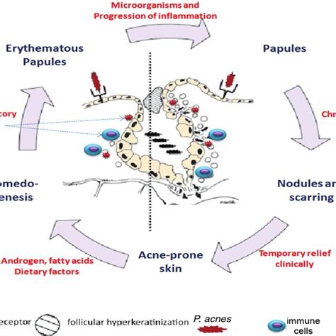 Inflammatory Mechanisms Involved In Different Stages Of Acne Vulgaris