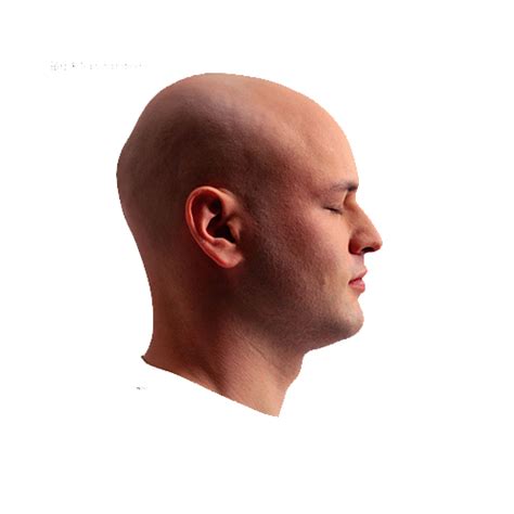 Botak Hair Loss Head Skin Man Side Face Png Download 500500 Free