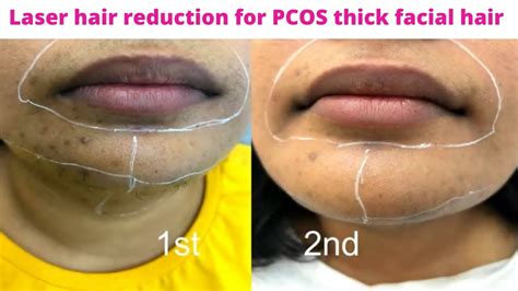 Laser Hair Session Vlog Pcos Facial Hair Removal Face Laser